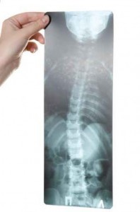 Scoliosis treatment & therapy at ogden chiropractic