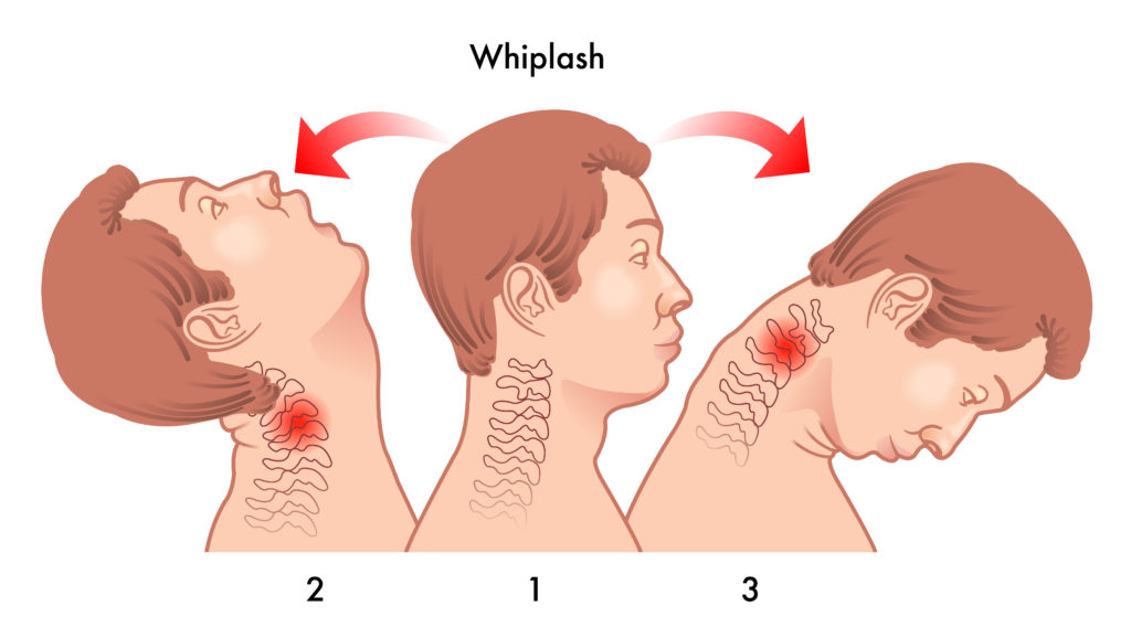 chiropractors help with whiplash