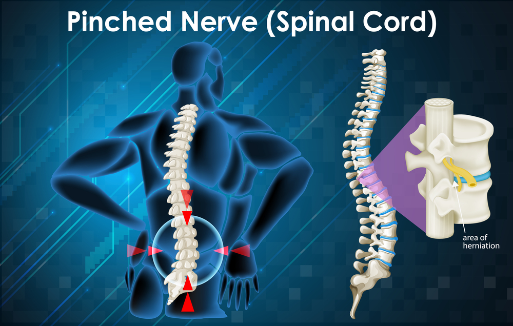 Can A Chiropractor Treat Pinched Nerves?